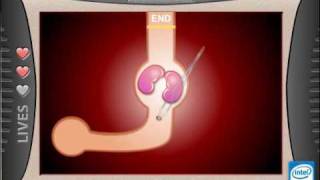 Extraction Reaction