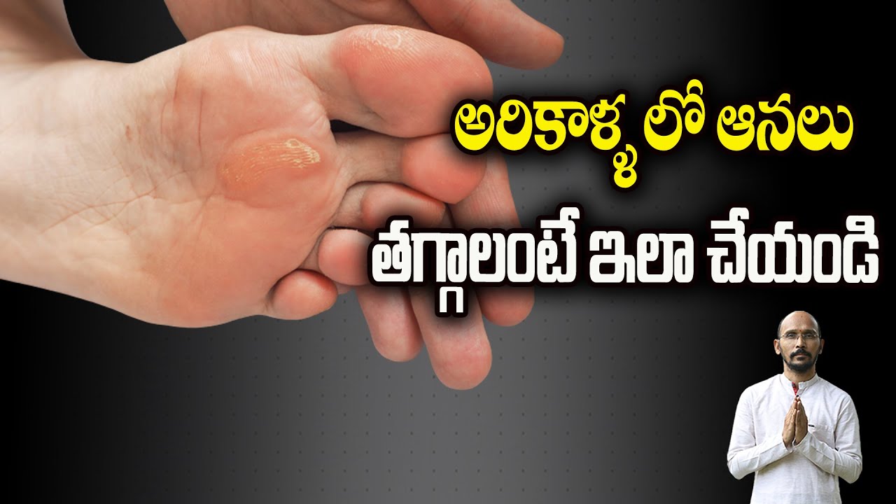 అరికాళ్ళ లో ఆనలు తగ్గాలంటే ఇలా చేయండి| Dr.Madhu Babu Health Trends