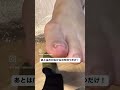 【巻き爪矯正】#shorts