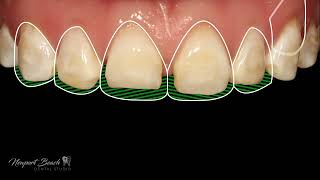 3D Printed Dental Veneers @ Newport Beach Dental Studio screenshot 3