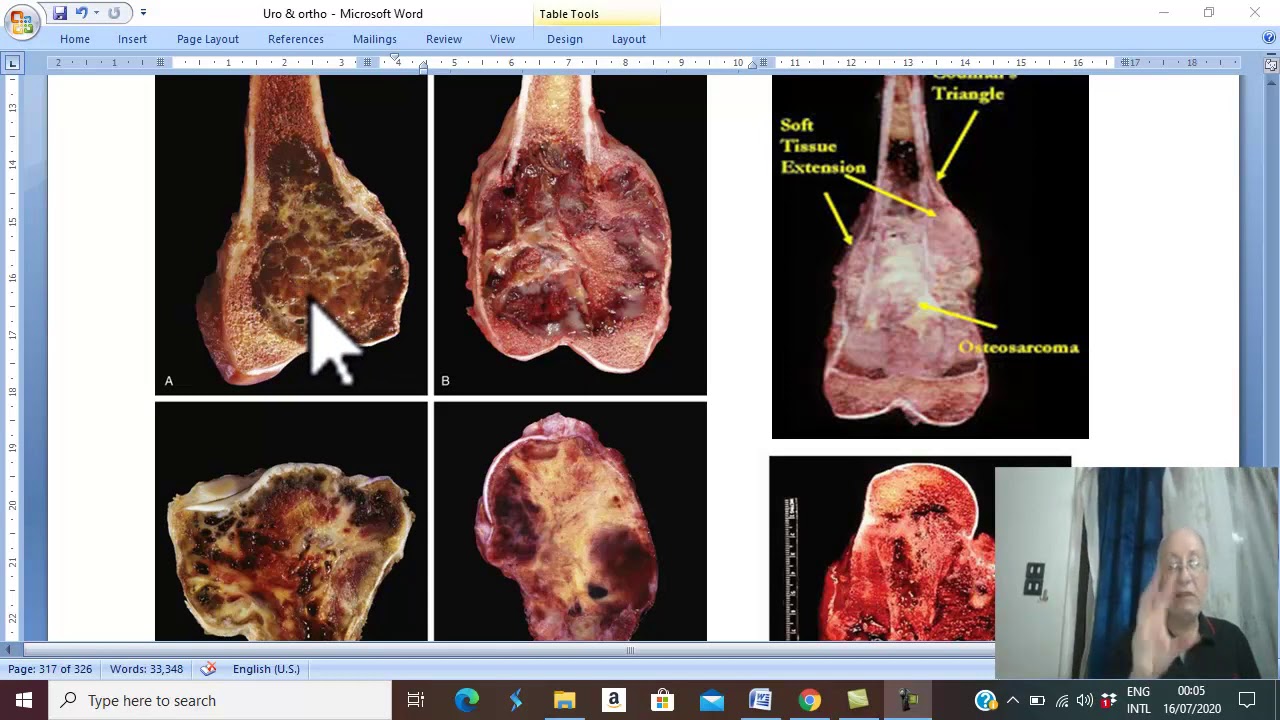 Orthopaedic in Arabic 60  ( Giant cell tumour , pathology) , by Dr.Wahdan