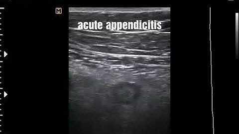 Acute appendicitis sonography with narration