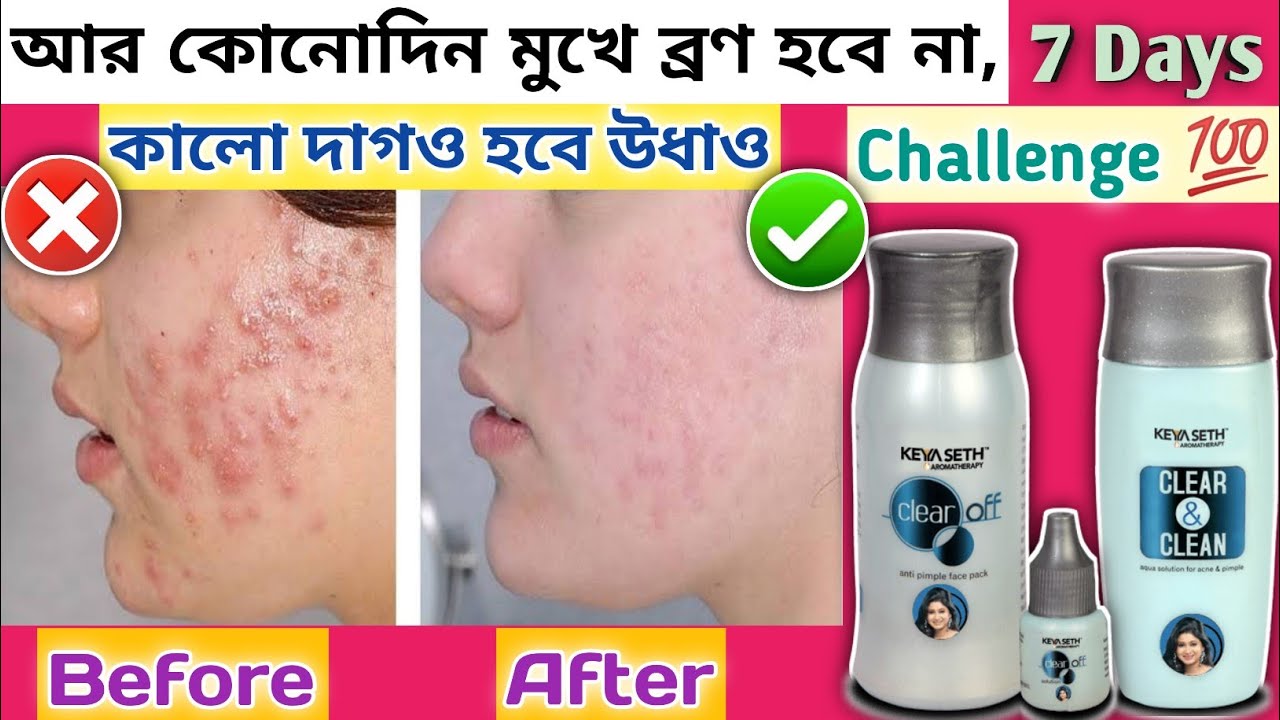 Keya Seth Clear Off Anti Pimple Face Pack & Clear & Clean Aqua Solution Review || Acne Treatment