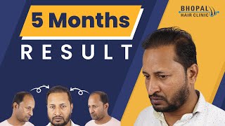 5 Months Amazing Hair Transplant Results | Best Hair Transplant Treatment | 100% Assured Results.