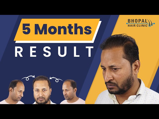 5 Months Amazing Hair Transplant Results | Best Hair Transplant Treatment | 100% Assured Results. class=