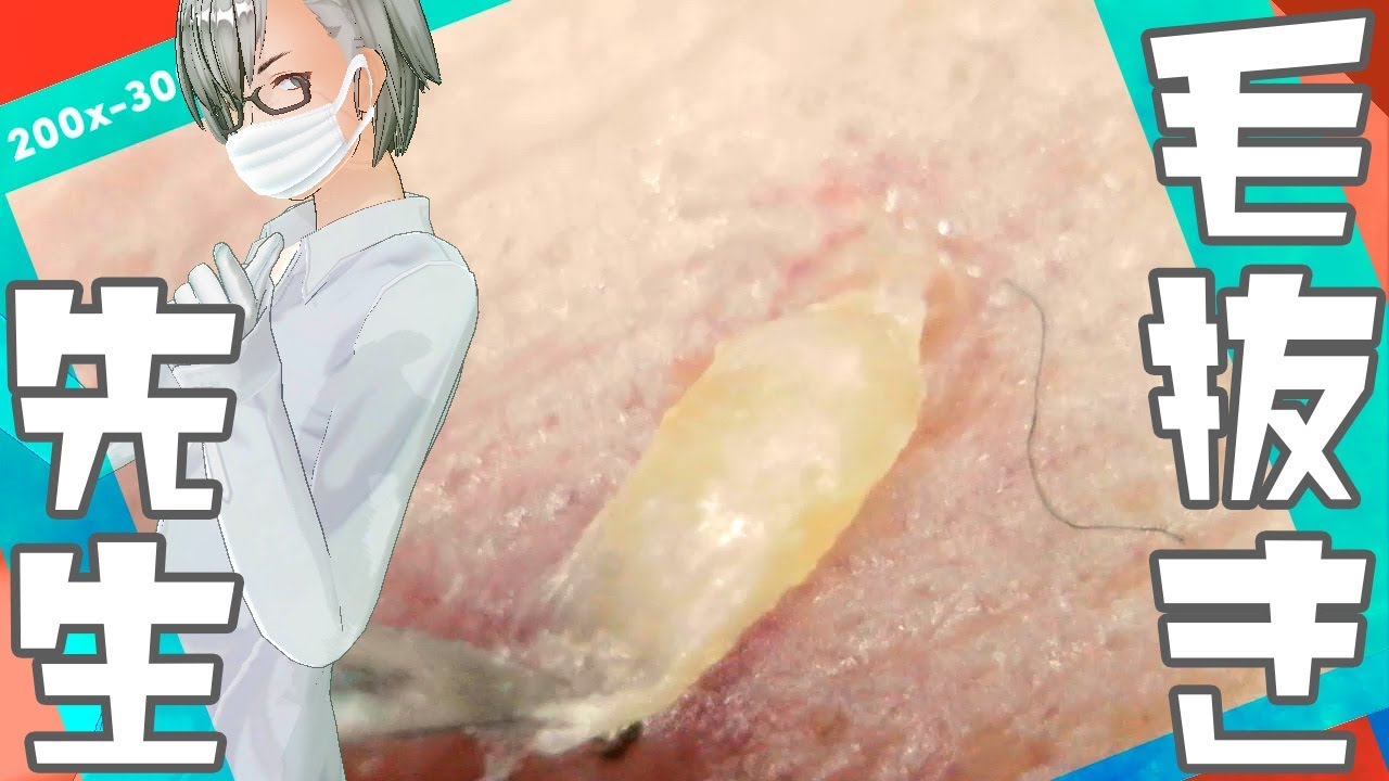 142 0x Zoom Large Horn Dr Tweezers 毛抜き先生の角栓や毛根 Youtube