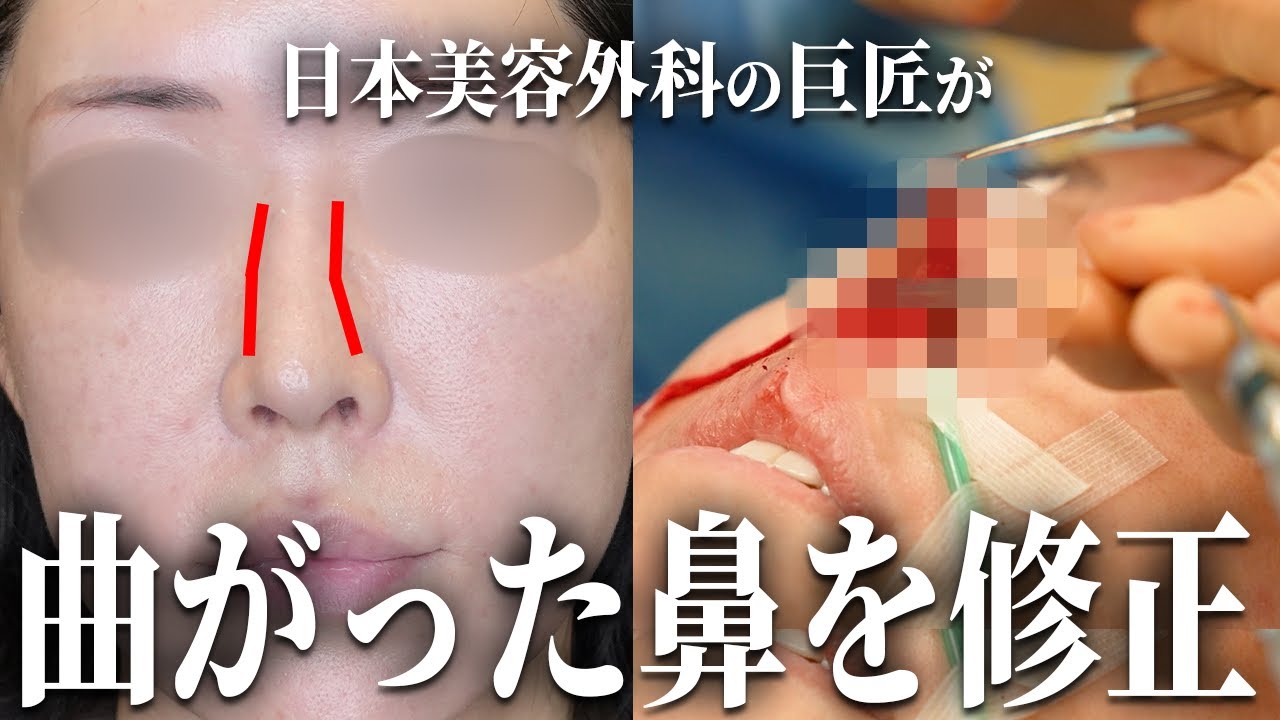 鼻形成術 = Aesthetic Rhinoplasty : 美容外科手術手技 Rhinoplasty] Revealing the corrective surgery! Making a crooked