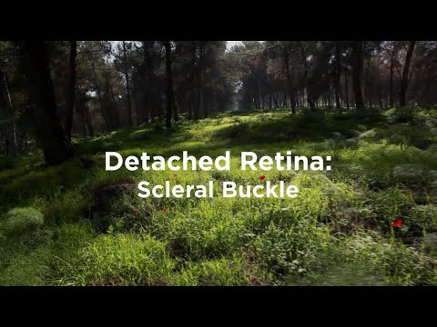 Detached Retina: Scleral Buckle