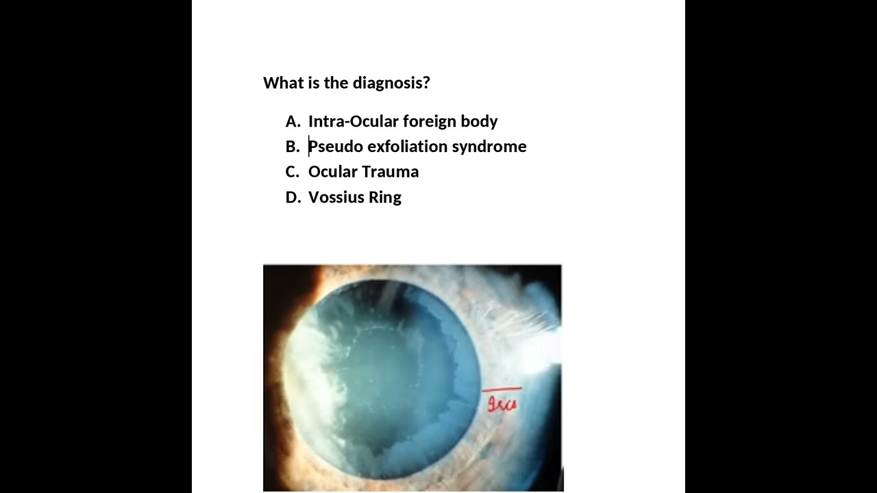 Axenfeld-Rieger Syndrome - Clinical Tree, image size:1280x720