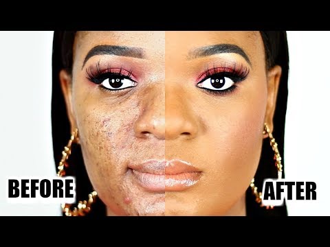 LARGE PORES? ACNE SCARS?? BUMPY SKIN??? HOW TO COVER PROBLEMATIC SKIN WITH MAKEUP | OMABELLETV