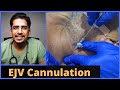 Ejv external jugular vein cannulation in 5 mins