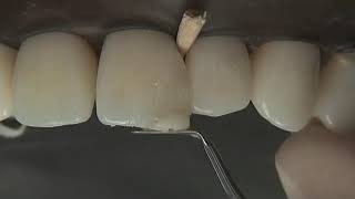 Class IV Composite Preparation & Restoration | Operative Dentistry