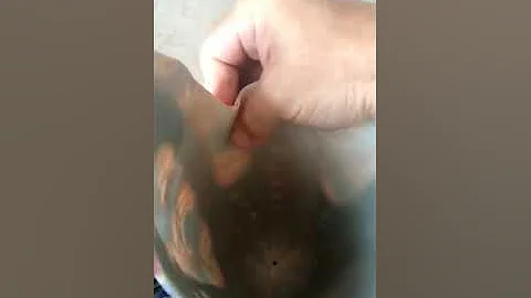 Protheflex - BK socket - Prosthetic Solutions of Indiana – USA