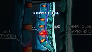 ⚡ Inside Your Spine: MRI vs. CT Scan for Lumbar Radiculopathy Explained!