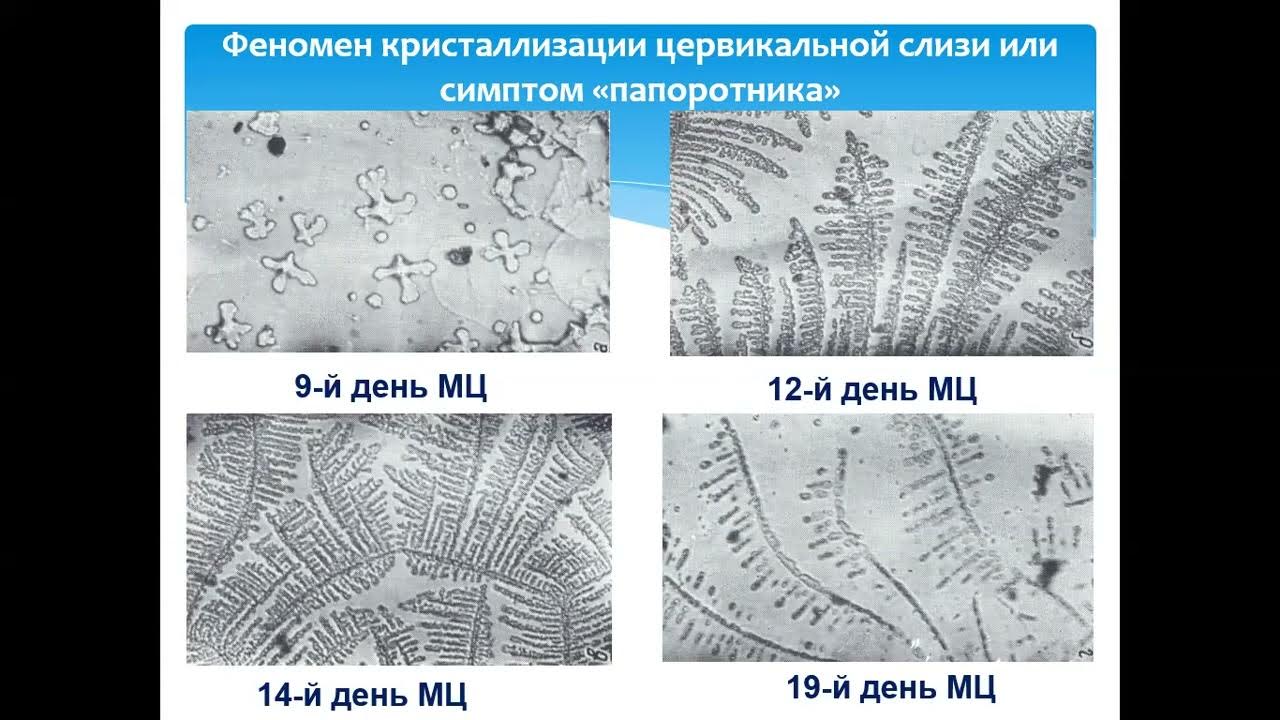 Слизистая при овуляции. Симптом кристаллизации цервикальной слизи (феномен «папоротника»). Исследование шеечной слизи симптом папоротника. Исследование цервикальной слизи симптом папоротника. Феномен кристаллизации шеечной слизи.