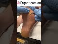 Amazing Hard Corn Removal at Podiatry Clinic #Podiatry #FootCare