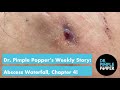 Dr. Pimple Popper's Weekly Story: Abscess Waterfall, Chapter 4!