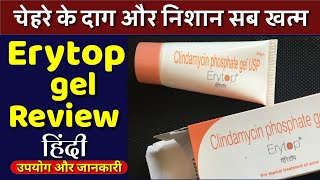 Erytop Gel दन और नशन हफत भर म सफ कर द बन Side Effect क Clean Pimple & Acne Hindi