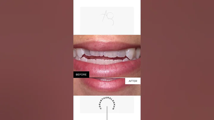 Smile makeover before and after #shorts