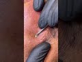 Cleaning and polishing the skin from worms #shorts