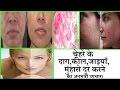 चेहरे के सारे पिंपल्स और दाग-धब्बे को पूरी तरह से साफ कर देगा यह आयुर्वेदिक नुस्खा