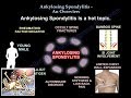 Ankylosing Spondylitis An Overview - Everything You Need To Know - Dr. Nabil Ebraheim