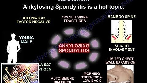 Ankylosing Spondylitis An Overview - Everything You Need To Know - Dr. Nabil Ebraheim