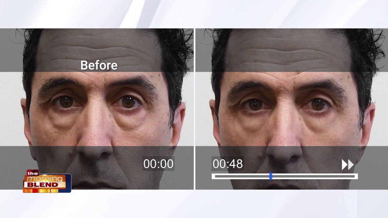 Clear The Bags Under Your Eyes With Plexaderm, It Works - YouTube