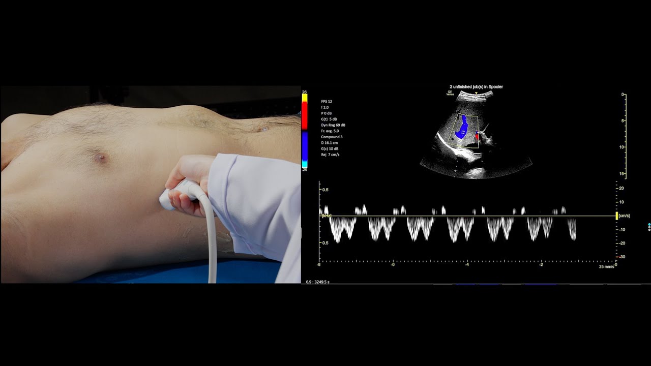VExUS — это просто: 4 простых шага для оценки венозного застоя