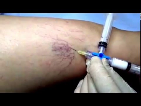 metoda de injectare pentru varicoza