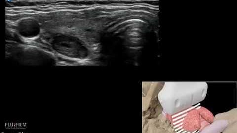 How To: Pathology Thyroid 3D Video