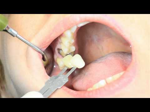 Vídeo: Próteses De Coroa Dentária