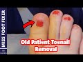 Old Patient Toenail Treatment *** How to Remove Toenail *** by miss foot fixer