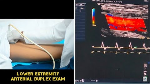 Lower Extremity Arterial Duplex Exam