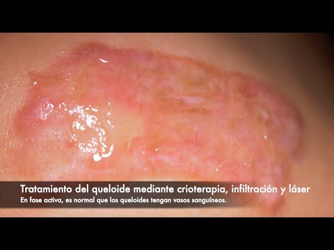 Dr. Didac Barco - Tratamiento de queloide mediante crioterapia, infiltración y láser.