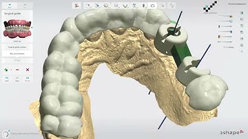 The digital planning of surgical intervention for a bridge on two implants