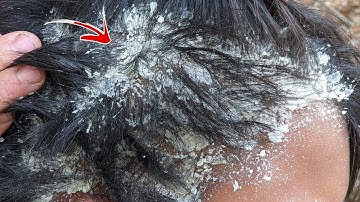 Dandruff Shampoo and Scratching, Itchy Dry Scalp, Huge Flake - Psoriasis #91