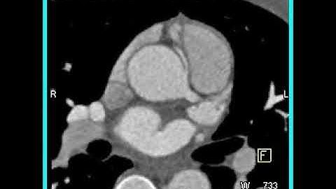 Cardiac: 3D and 4D mapping of a coronary CTA (6 of 6)