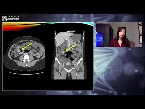 NETs Imaging - Dr. Denise Chan (Radiologist & Nuclear Medicine)