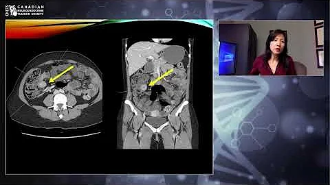 NETs Imaging - Dr. Denise Chan (Radiologist & Nuclear Medicine)