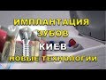 Имплантация зубов Киев - Новые технологии и отзывы (Імплантація зубів Київ)