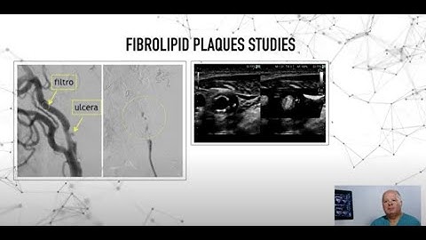 Fibrolipid plaque detection in vascular ultrasound