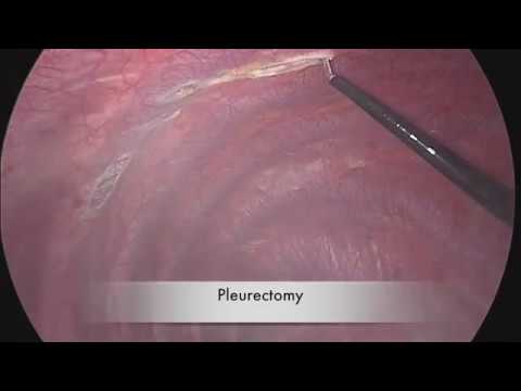 VATS Blebectomy with Pleurectomy