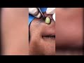 Popping huge blackheads and giant pimples  best pimple poppings 98