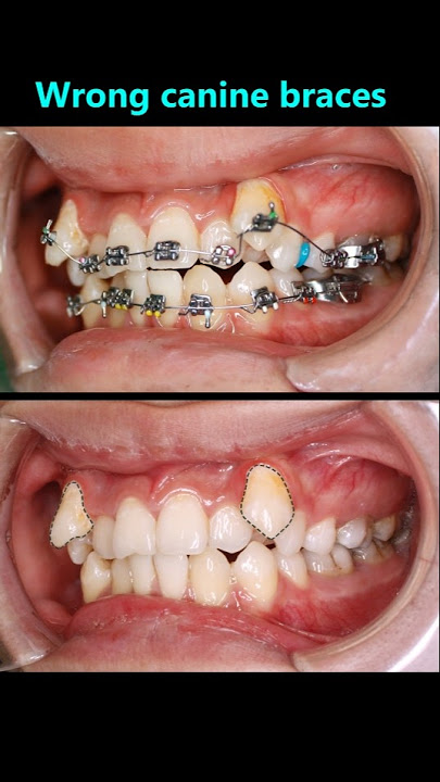 Braces for wrong canine teeth. Amazing after 18 months #braces #orthodontist #bracesjourney