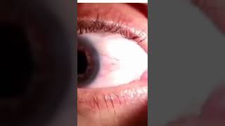 iridocyclitis reels eyedefect trending viral videoyt short