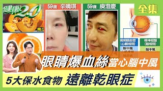 眼睛爆血絲 眼睛乾澀 當心腦中風 自體免疫疾病護眼5大保水食物 遠離乾眼症 健康2.0 20210911 (完整版)