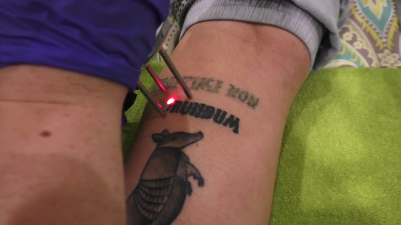 Innovative New Enlighten Machine Promises Nearly Complete Tattoo Removal   Tattoo Ideas Artists and Models
