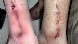 Time Lapse of my Ankle Healing (GRAPHIC)