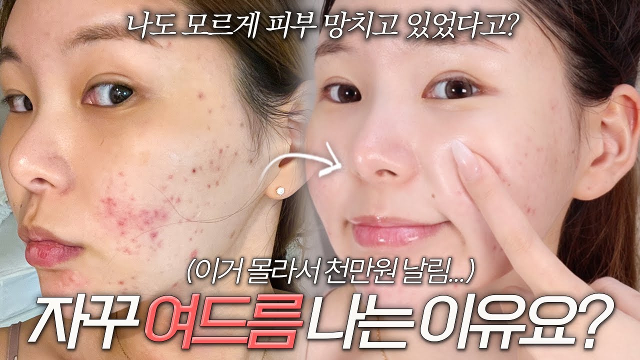 100% 효과있는 여드름+지성피부 클렌징 꿀팁🔥 | 올영세일 추천템🫒 | 지성피부 클렌징 | 이거 모르면 관리해도 의미없음❌ | 조말랭